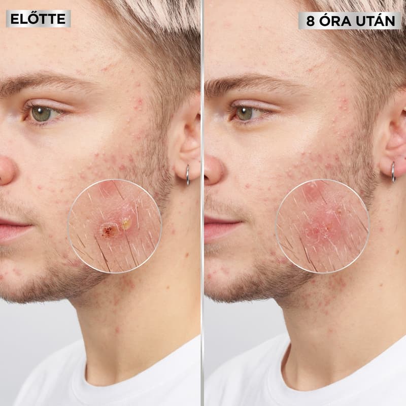 Garnier Pure Active Pimple patch láthatatlan pattanás tapasz BHA-val